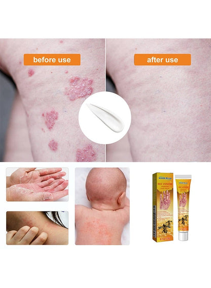 South Moon - Bee Venom Psoriasis Care Cream